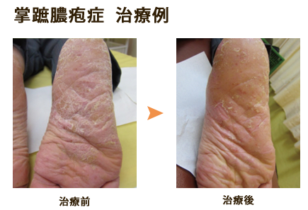 掌蹠膿疱症治療写真